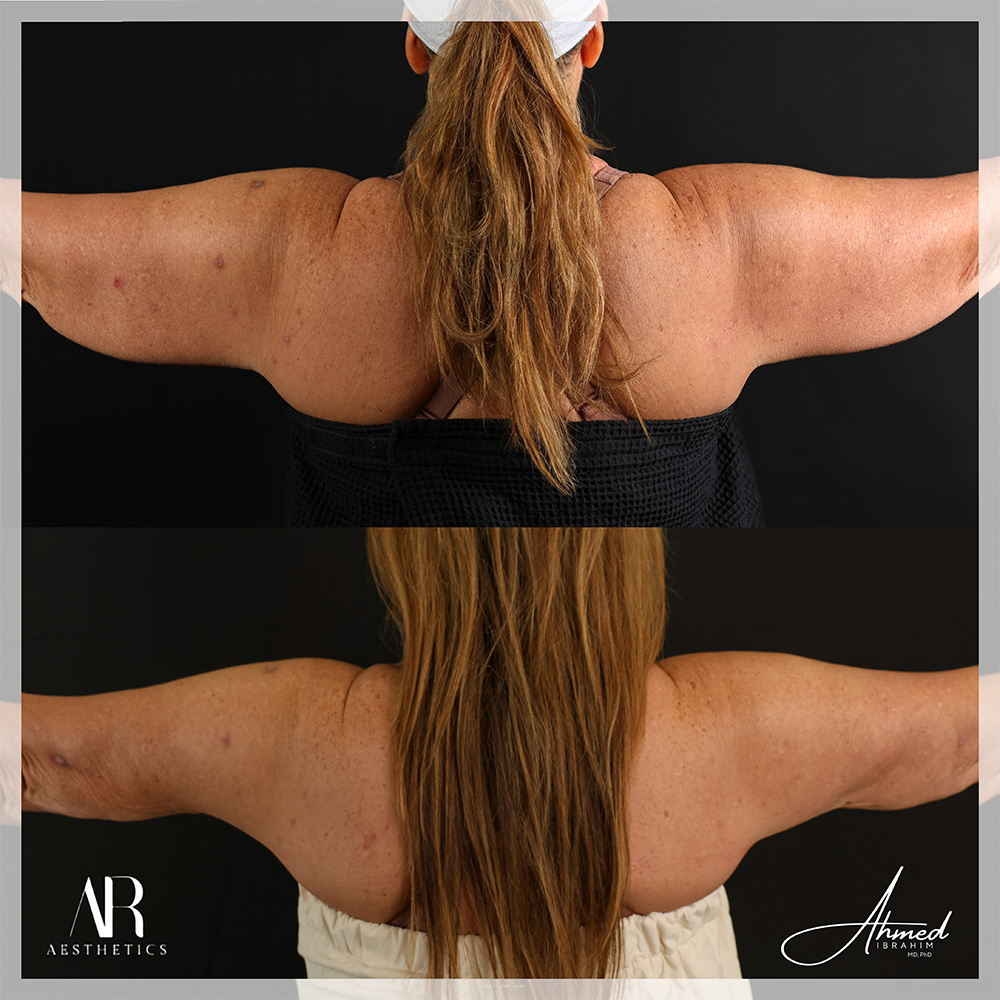 Real Patient Results Arm Lift (ArmSculpt) by Ahmed Ibrahim MD, PhD