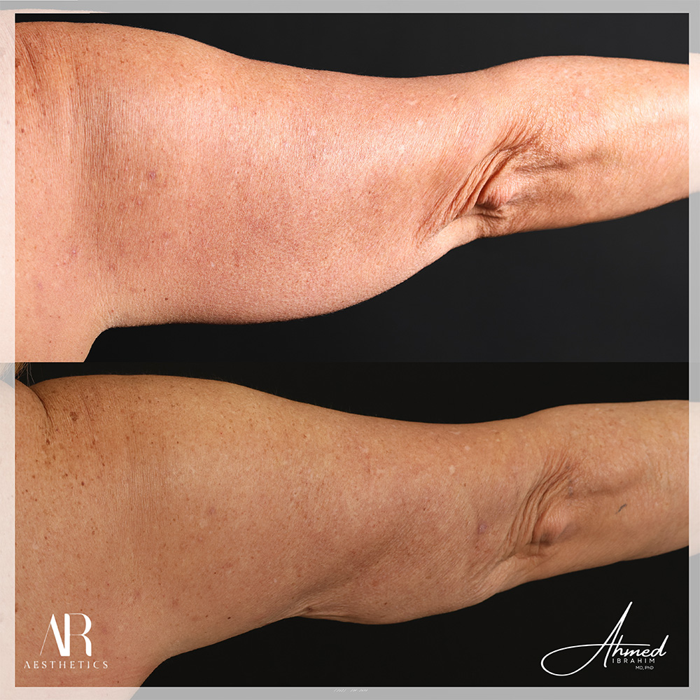 Real Patient Results Arm Lift (ArmSculpt) by Ahmed Ibrahim MD, PhD