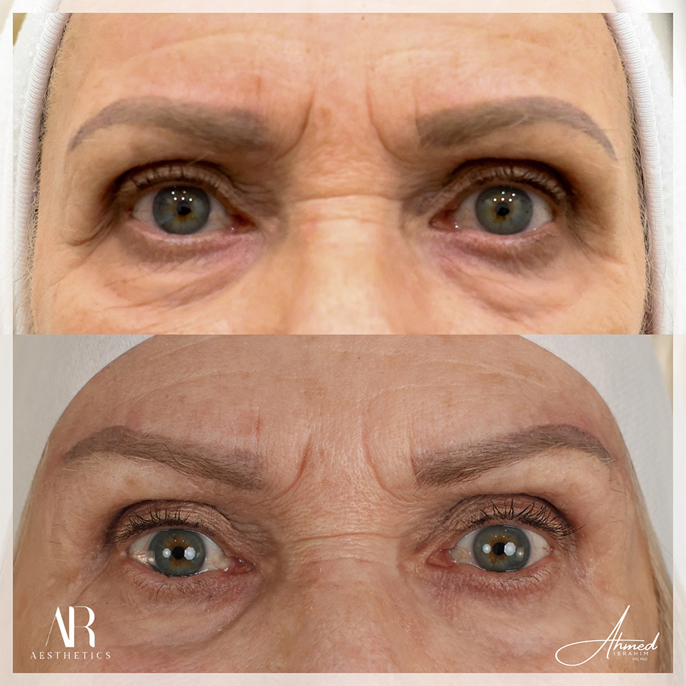 Real Patient Results Brow Lift by Ahmed Ibrahim MD, PhD