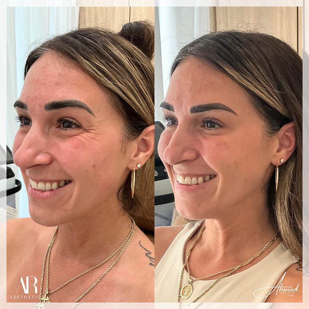 botox