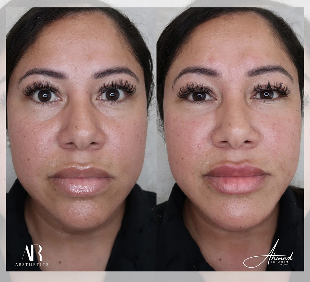 Real Patient Results Filler Treatment by Ahmed Ibrahim MD, PhD