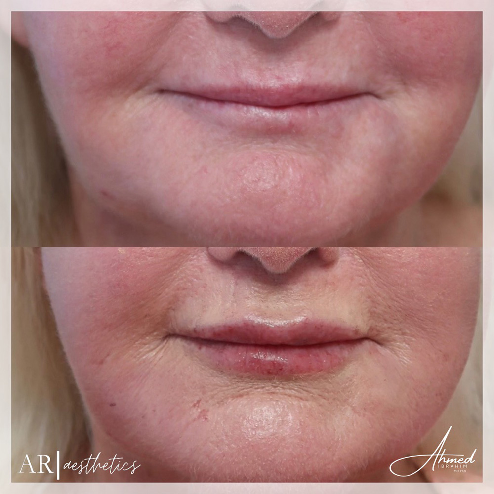 Real Patient Results Filler Treatment by Ahmed Ibrahim MD, PhD