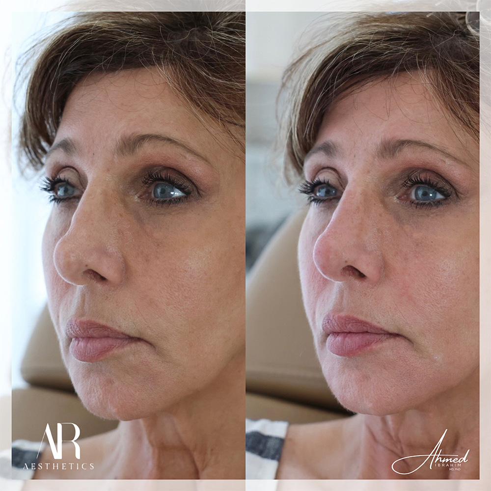 Real Patient Results Filler Treatment by Ahmed Ibrahim MD, PhD