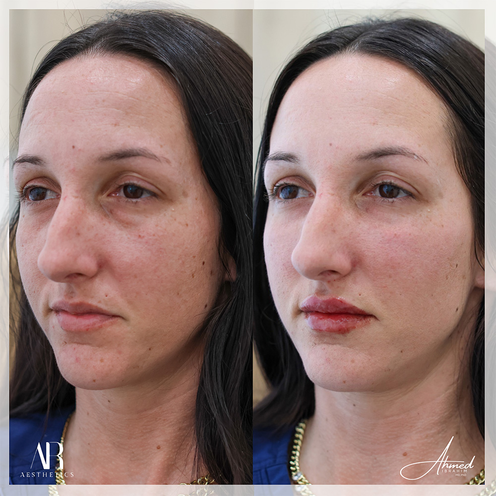 Real Patient Results Filler Treatment by Ahmed Ibrahim MD, PhD
