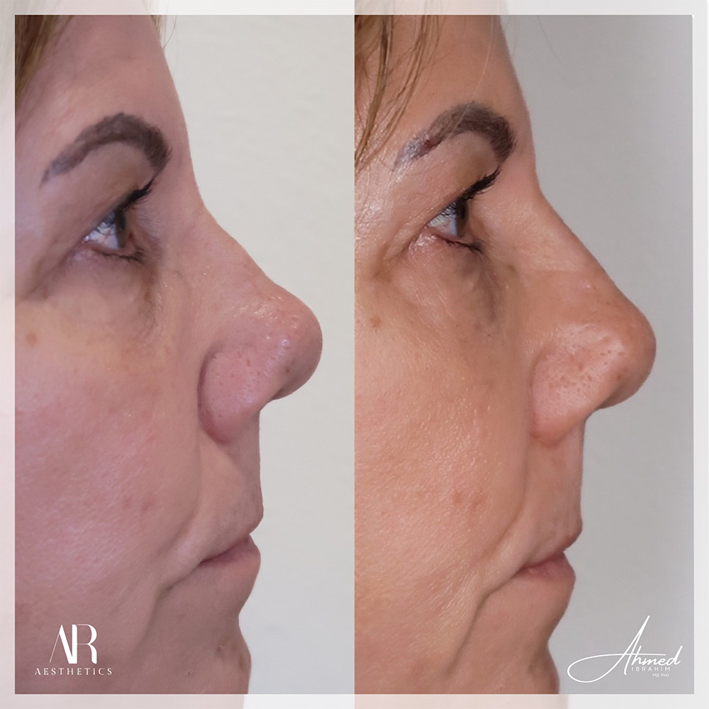 Real Patient Results Filler Treatment by Ahmed Ibrahim MD, PhD