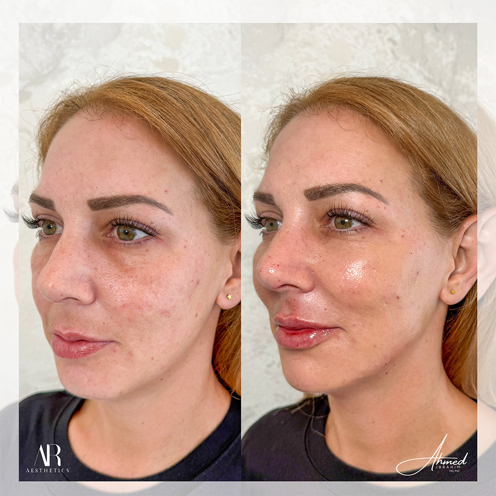 Real Patient Results Filler Treatment by Ahmed Ibrahim MD, PhD