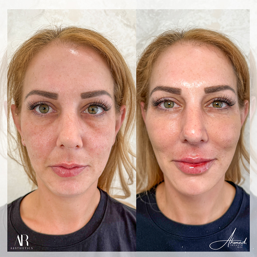 Real Patient Results Filler Treatment by Ahmed Ibrahim MD, PhD
