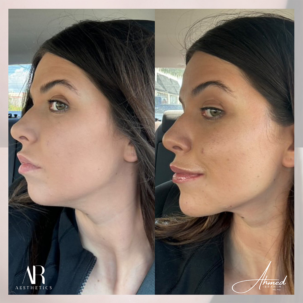 Real Patient Results Filler Treatment by Ahmed Ibrahim MD, PhD