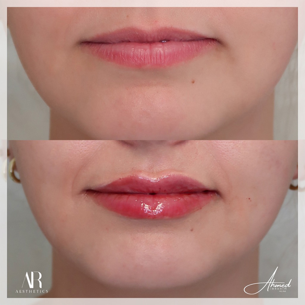 Real Patient Results Filler Treatment by Ahmed Ibrahim MD, PhD