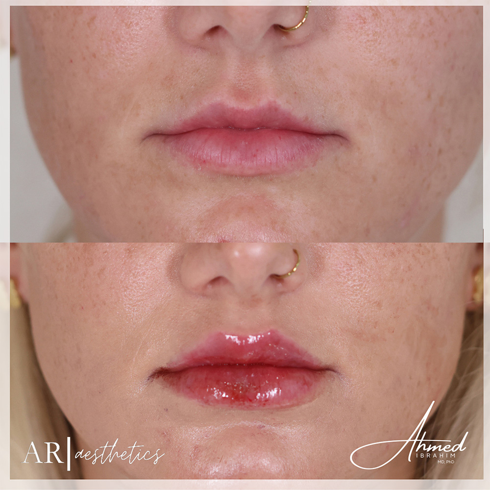 Real Patient Results Filler Treatment by Ahmed Ibrahim MD, PhD