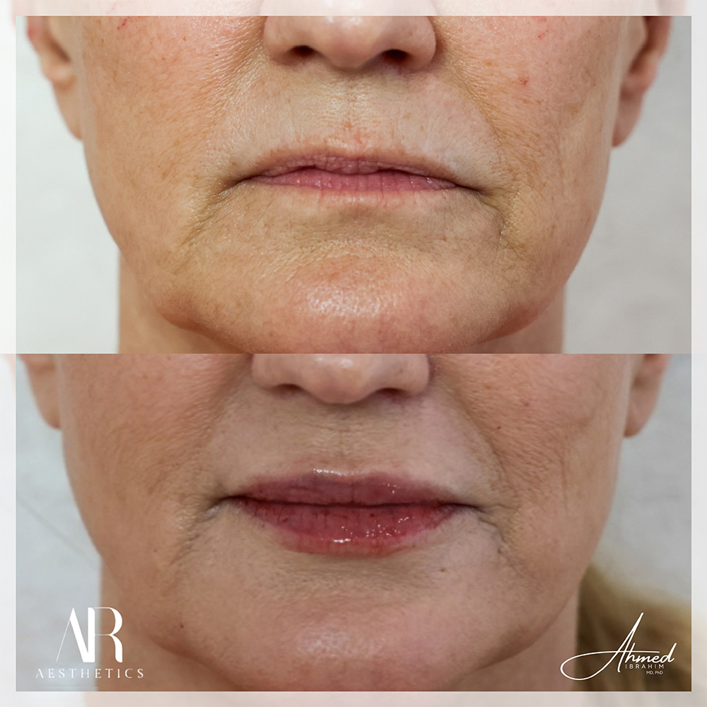 Real Patient Results Filler Treatment by Ahmed Ibrahim MD, PhD