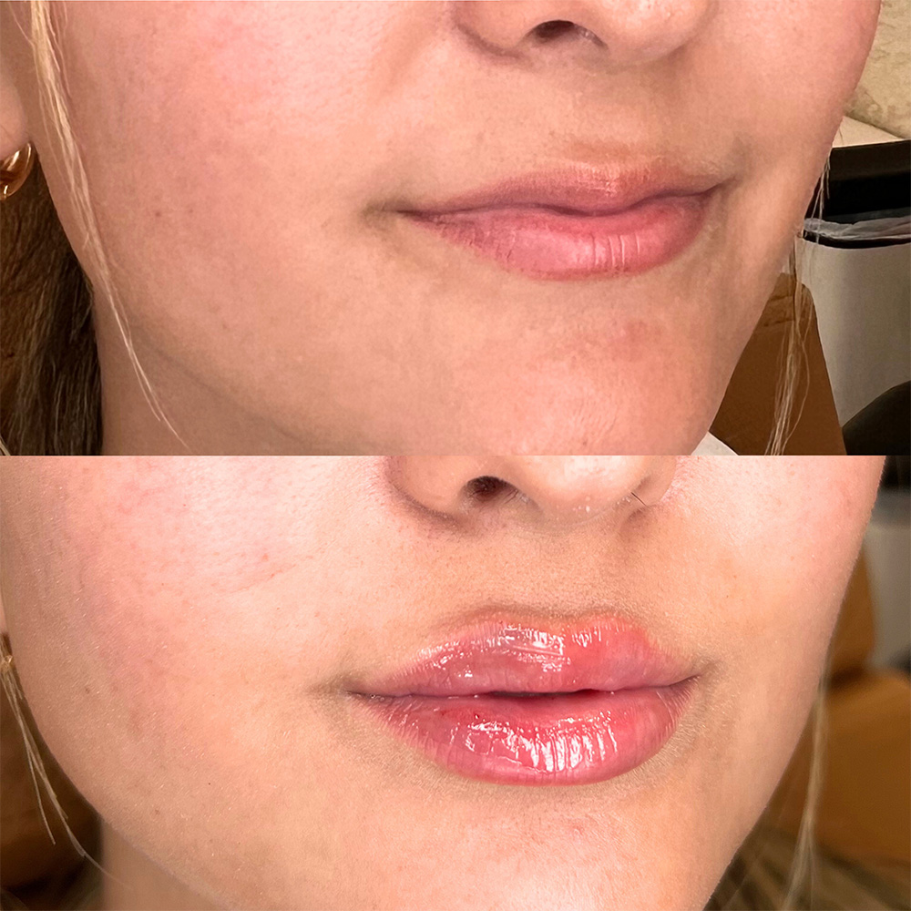 Real Patient Results Filler Treatment by Ahmed Ibrahim MD, PhD