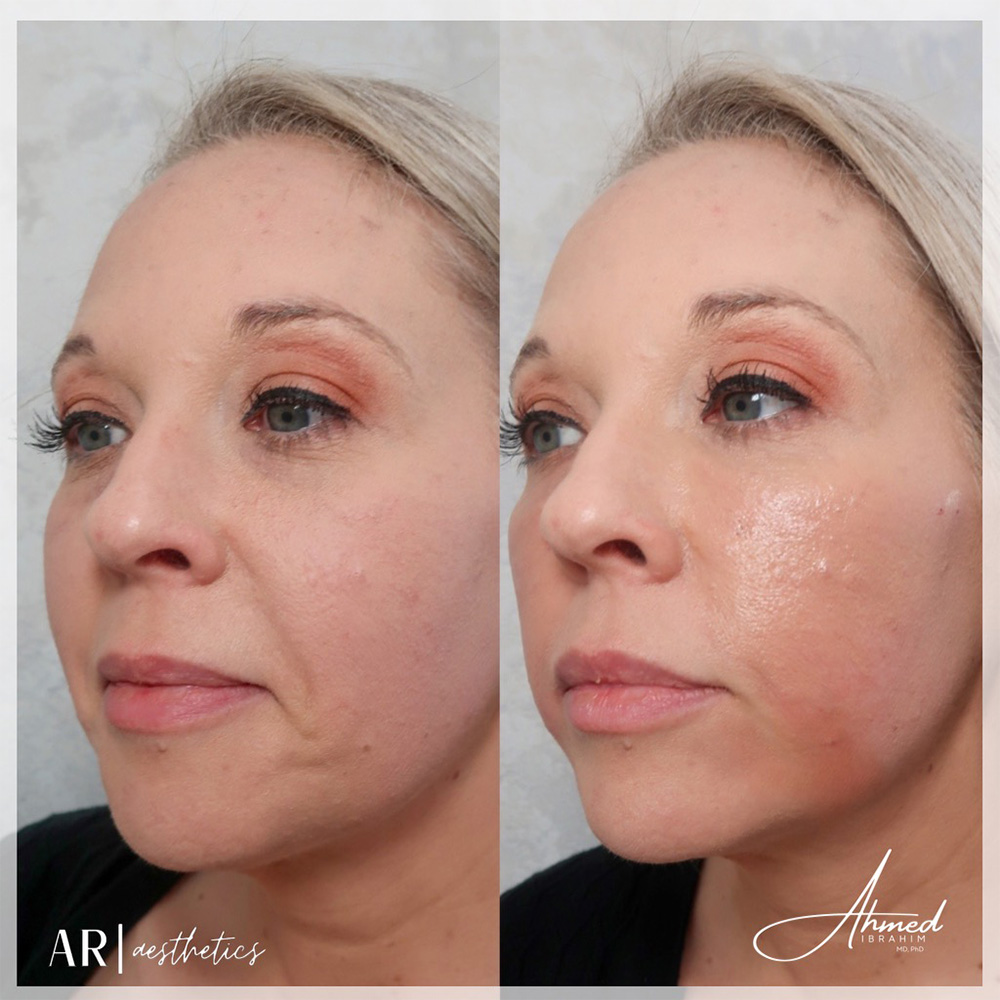 Real Patient Results Filler Treatment by Ahmed Ibrahim MD, PhD