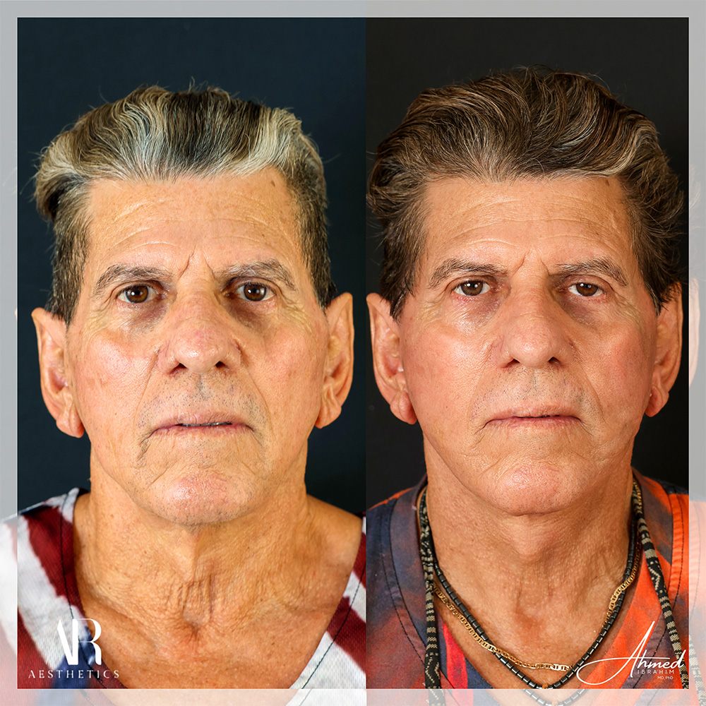 Real Patient Results Facelift (Serenity Lift) by Ahmed Ibrahim MD, PhD