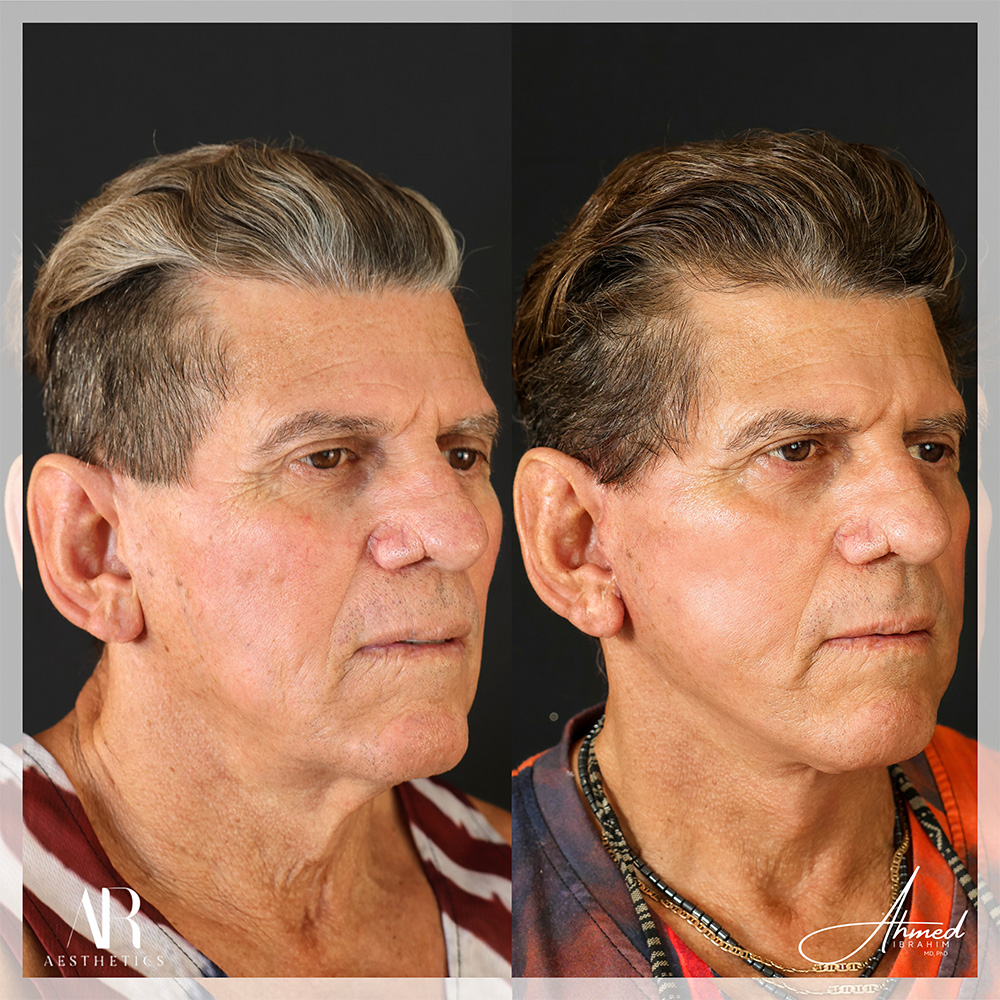 Real Patient Results Facelift (Serenity Lift) by Ahmed Ibrahim MD, PhD