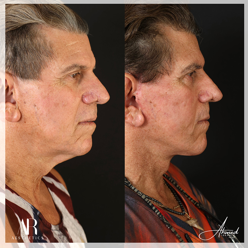 Real Patient Results Facelift (Serenity Lift) by Ahmed Ibrahim MD, PhD