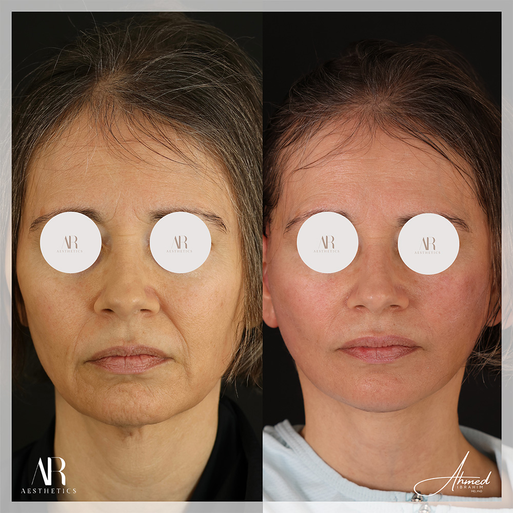 Real Patient Results Facelift (Serenity Lift) by Ahmed Ibrahim MD, PhD