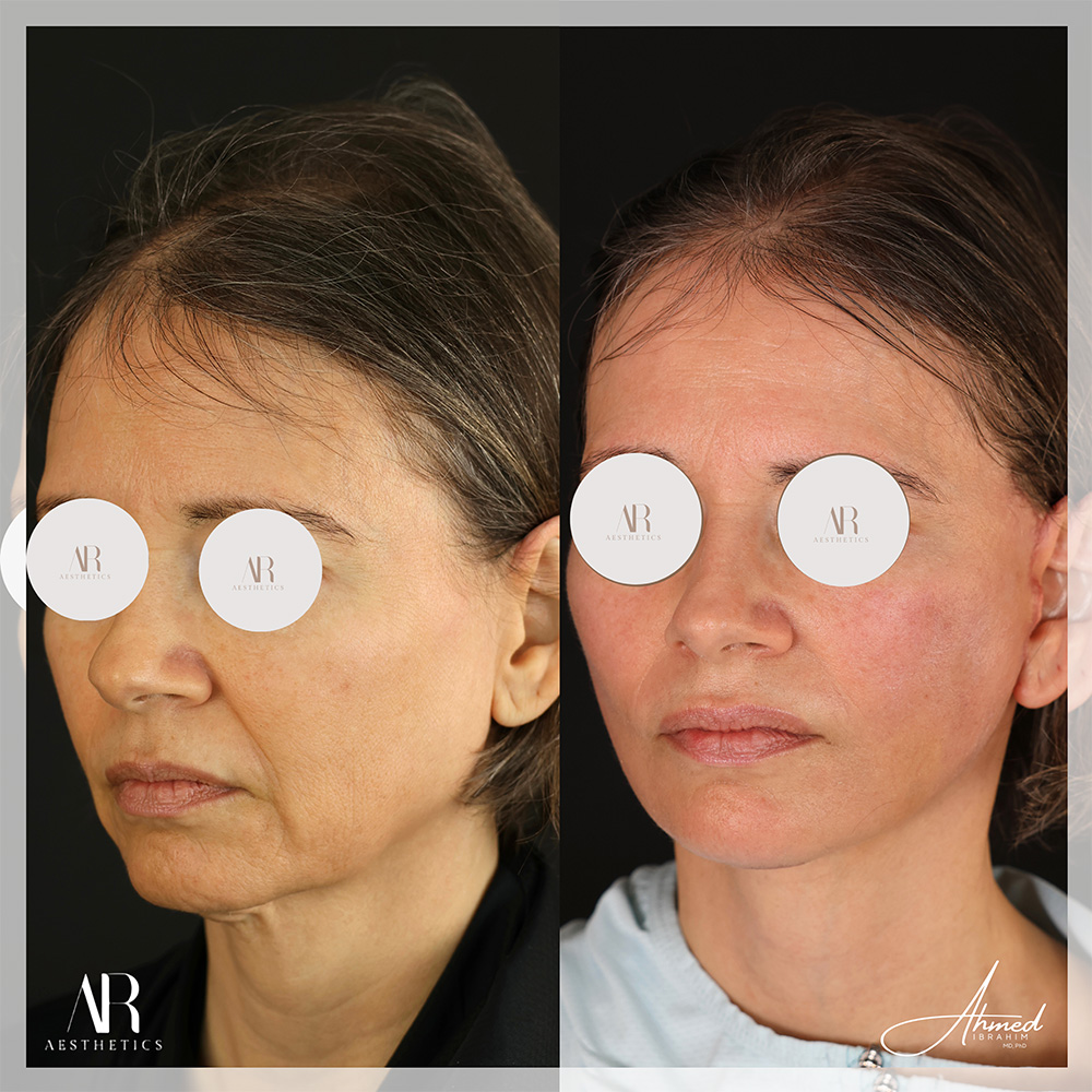 Real Patient Results Facelift (Serenity Lift) by Ahmed Ibrahim MD, PhD