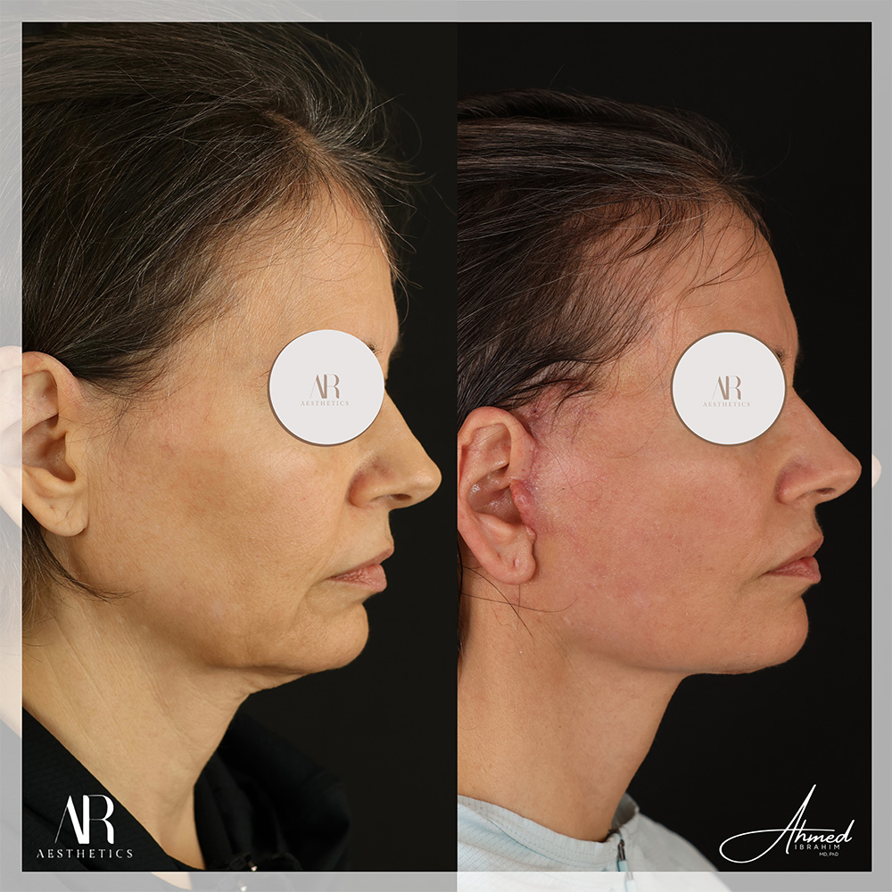 Real Patient Results Facelift (Serenity Lift) by Ahmed Ibrahim MD, PhD