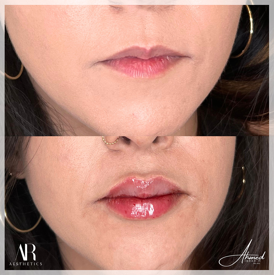 lip filler