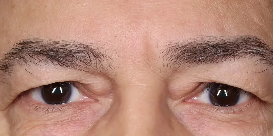ubl-4 before