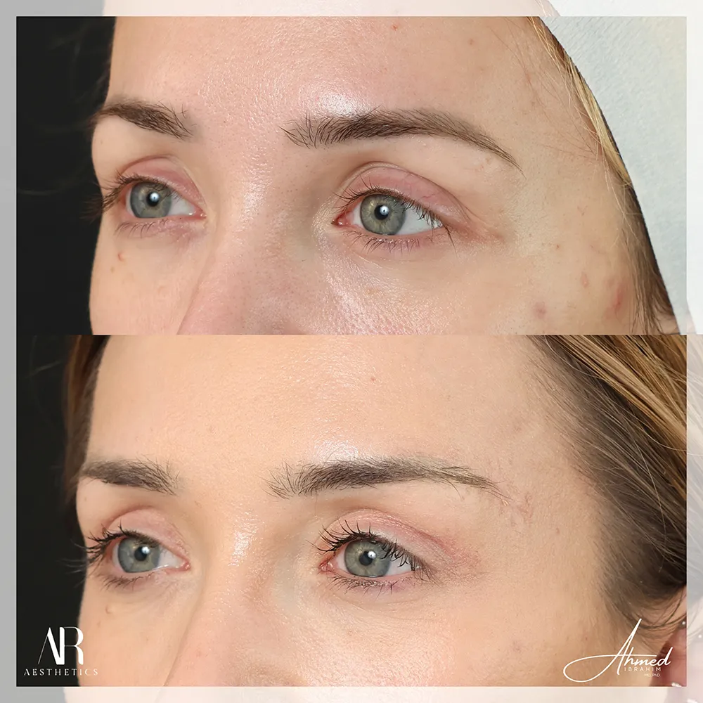 100 BA brow lift-2