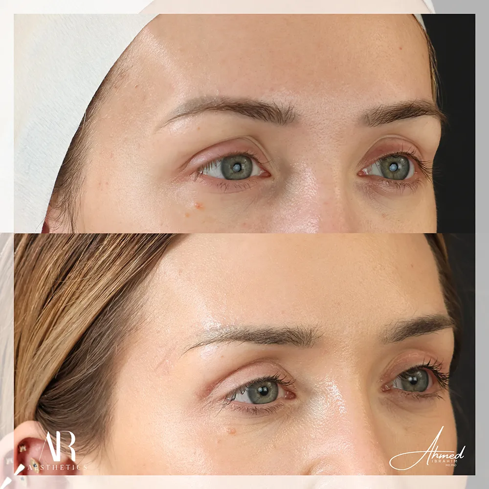 100 BA brow lift-3