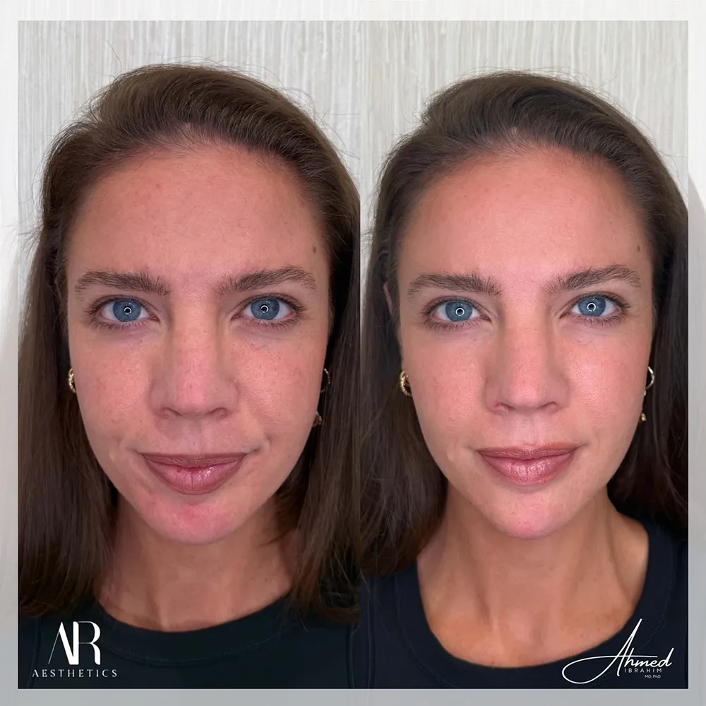 100 BA chin jaw filler-1