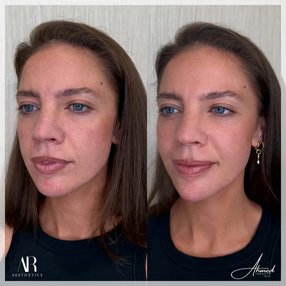 100 BA chin jaw filler-2