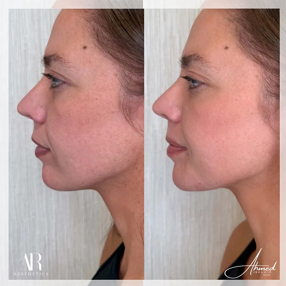 100 BA chin jaw filler-3