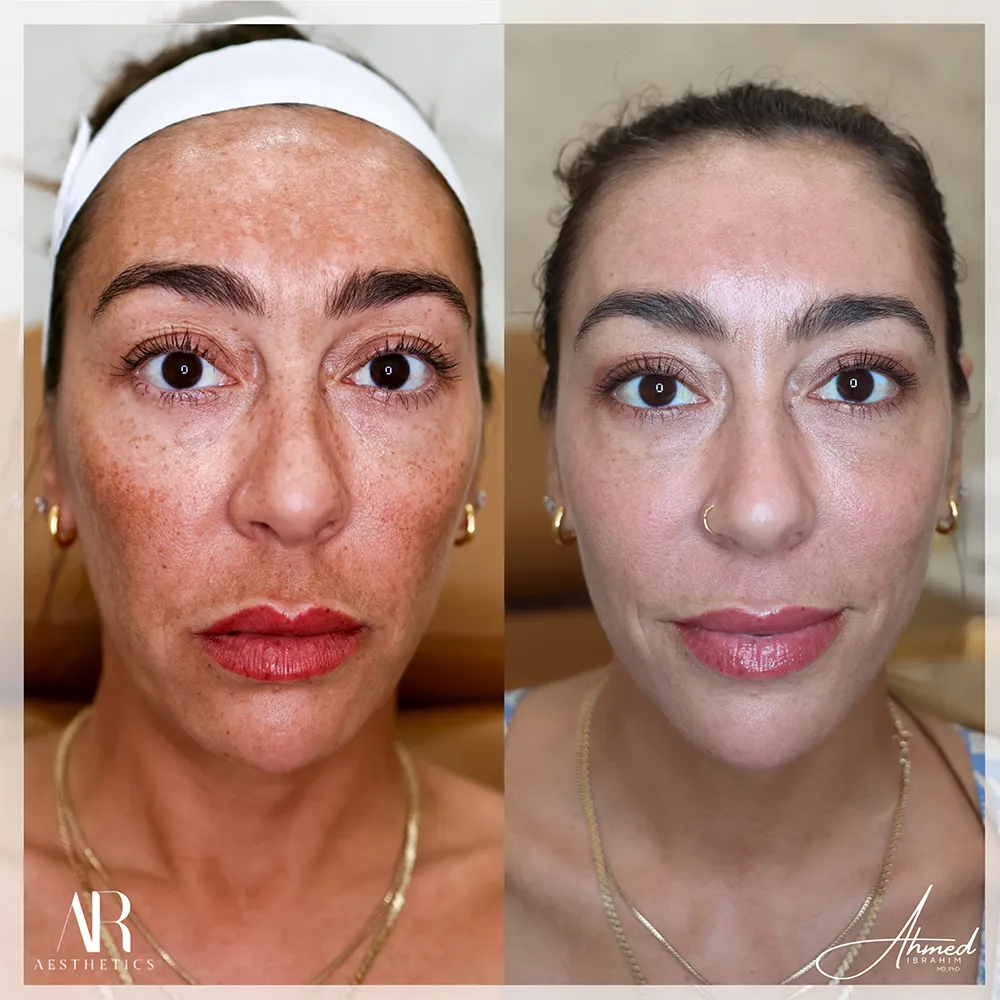 100 BA laser treatment-1