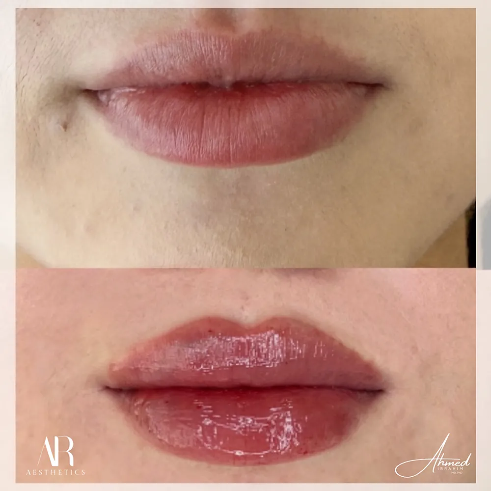 100 BA lip filler