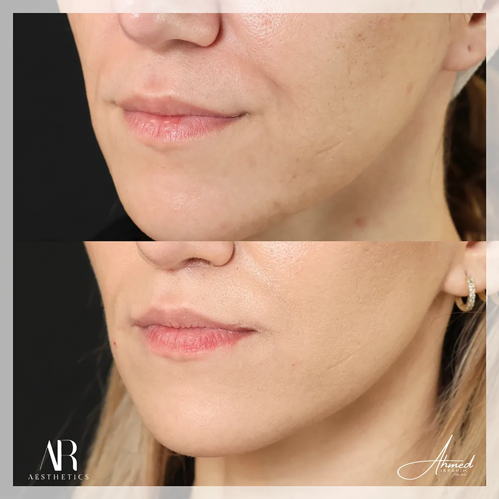 100 BA lip lift-1