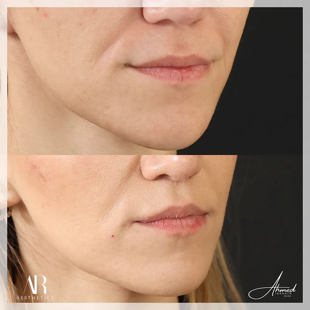 100 BA lip lift-2