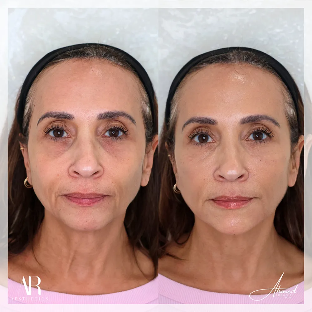 100 BA profile balancing-1