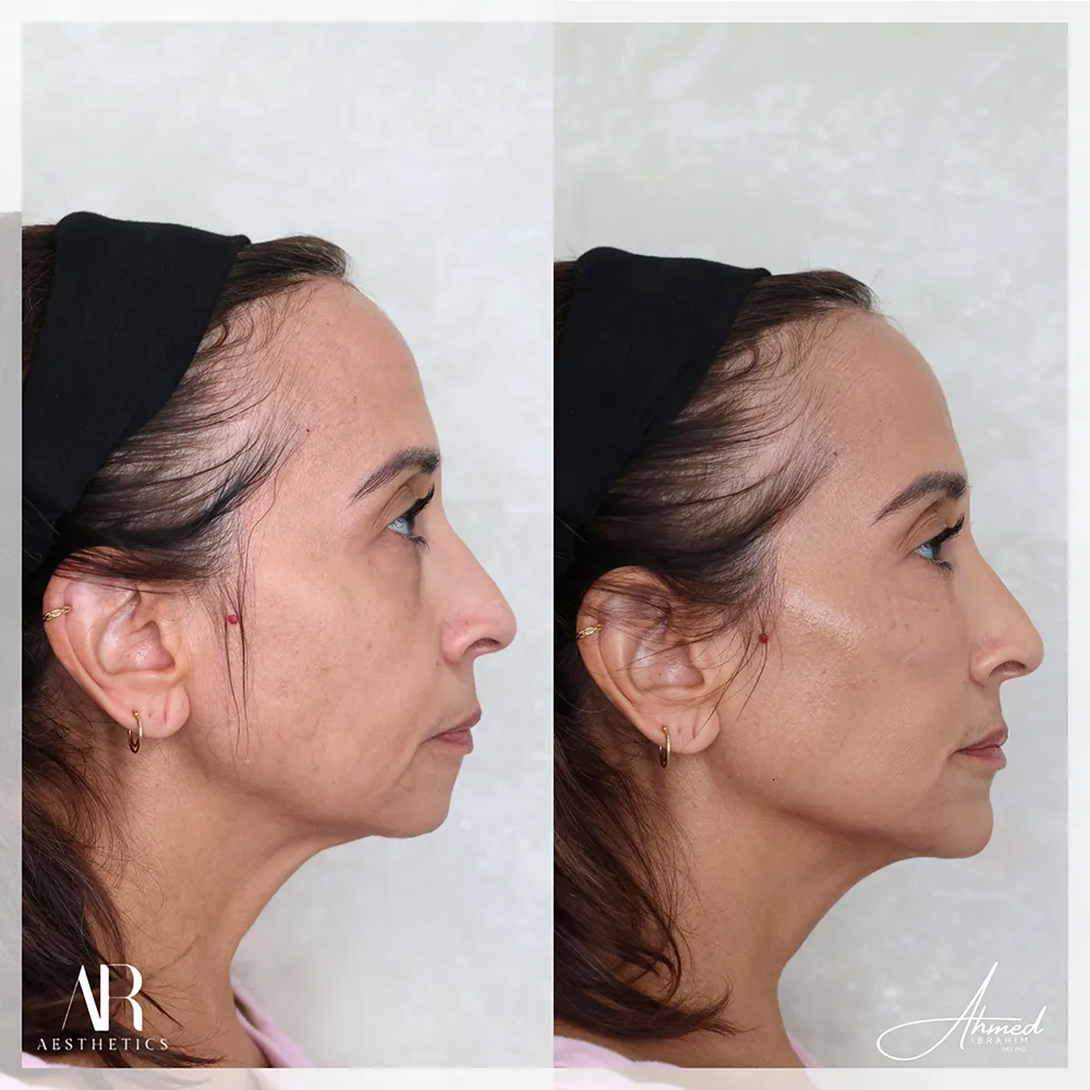 100 BA profile balancing-2