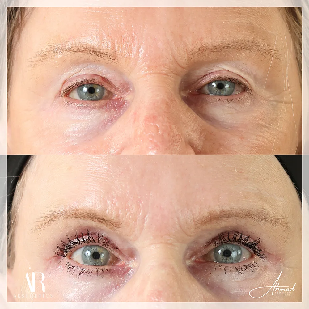 100 BA upper eyelid