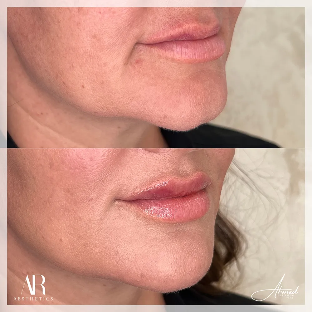 101 BA lip filler
