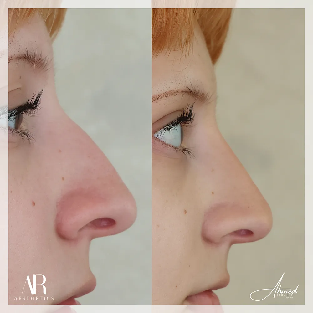 liquid-rhino-BA-01-1