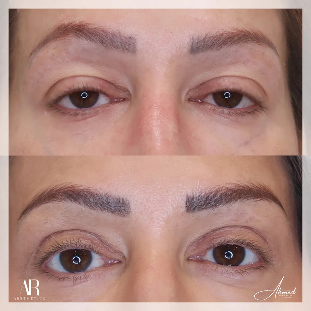 upper-eyelid-BA-01-1