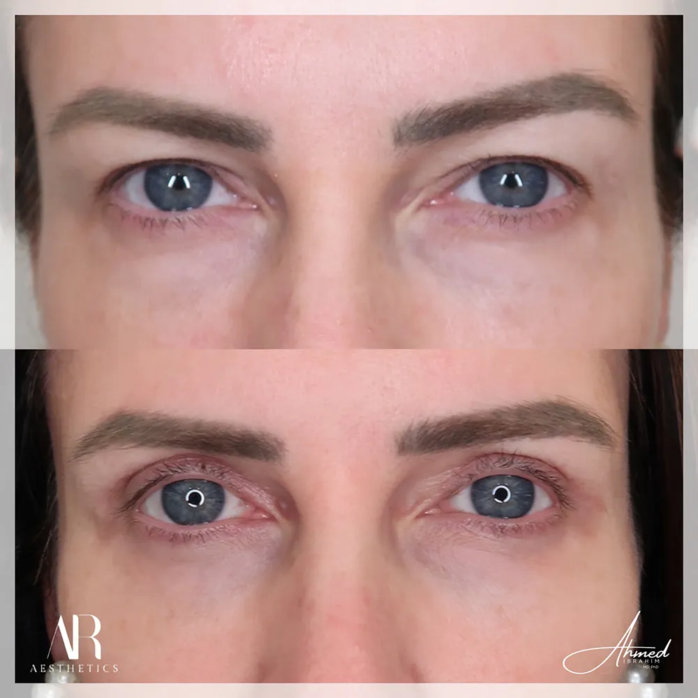 upper-eyelid-BA-02-1