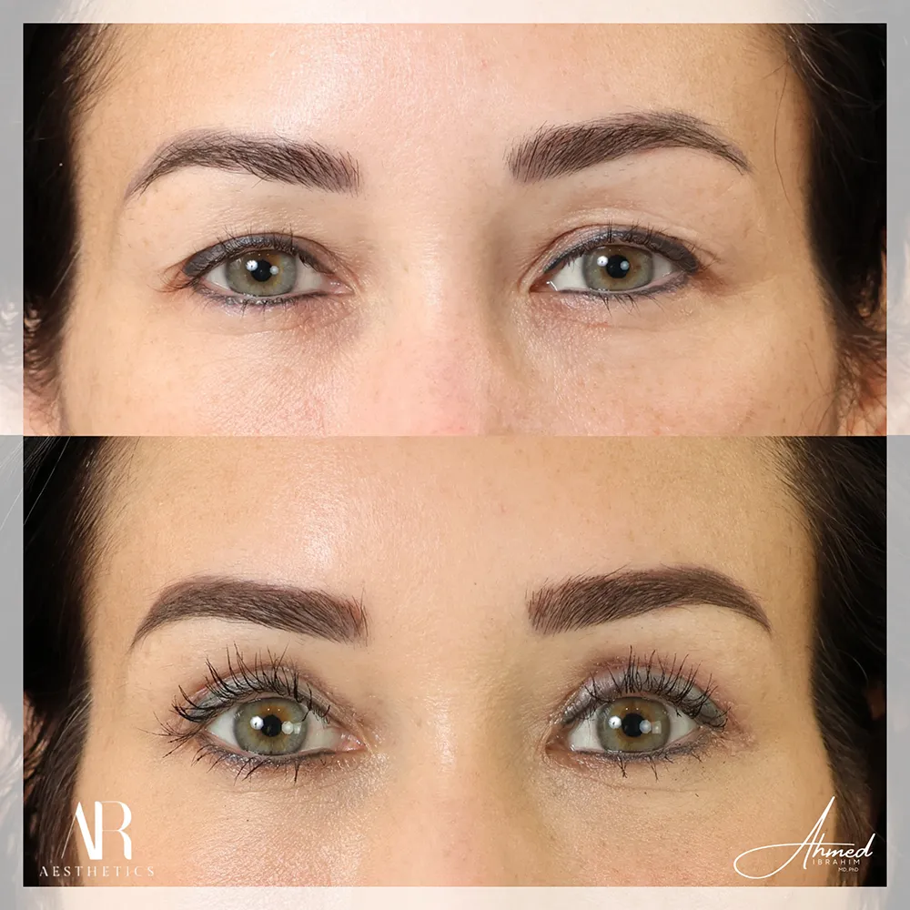 upper-eyelid-BA-03-1