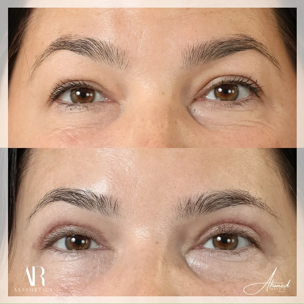 upper-eyelid-BA-04-1