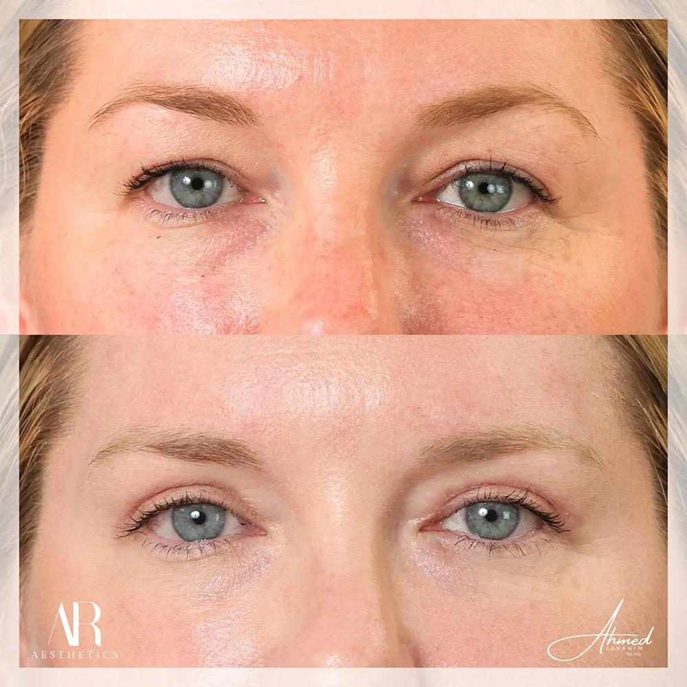 upper-eyelid-BA-05-1